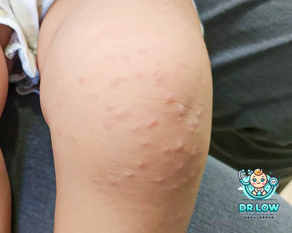 峇株巴辖父母请注意 - 关于手足口症 - HFMD - 刘医生小儿科专科诊所在一天内接诊了4例手足口病患者 A03