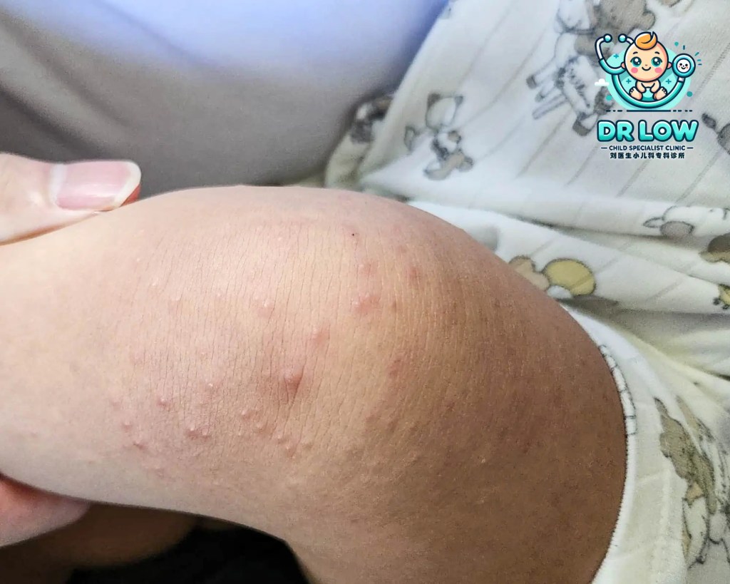 Ibu Bapa di Batu Pahat, Sila Berjaga-jaga - Mengenai Penyakit Tangan Kaki dan Mulut HFMD - 4 pesakit HFMD telah dilihat dalam sehari di Klinik Pakar Kanak-kanak Dr Low Batu Pahat A05