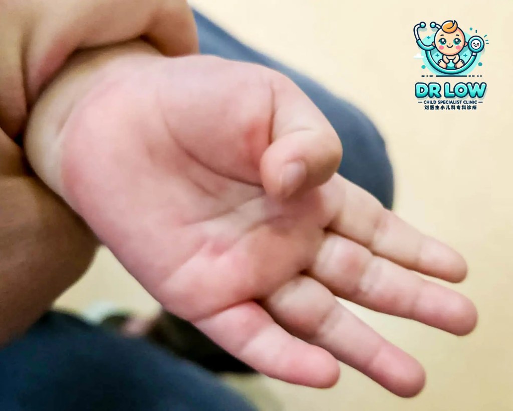 Ibu Bapa di Batu Pahat, Sila Berjaga-jaga - Mengenai Penyakit Tangan Kaki dan Mulut HFMD - 4 pesakit HFMD telah dilihat dalam sehari di Klinik Pakar Kanak-kanak Dr Low Batu Pahat A07