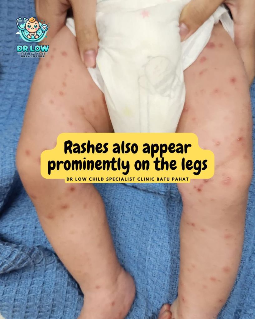 Segala Yang Perlu Diketahui Tentang Cacar Air Kanak-Kanak Batu Pahat - Klinik Pakar Kanak-kanak Batu Pahat Dr Low 06