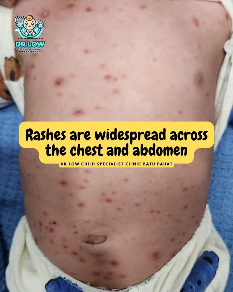 Understanding Chickenpox (Varicella) in Children Batu Pahat - Dr Low Child Specialist Clinic Batu Pahat 03