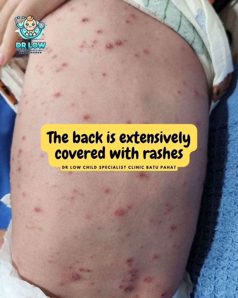 Understanding Chickenpox (Varicella) in Children Batu Pahat - Dr Low Child Specialist Clinic Batu Pahat 04