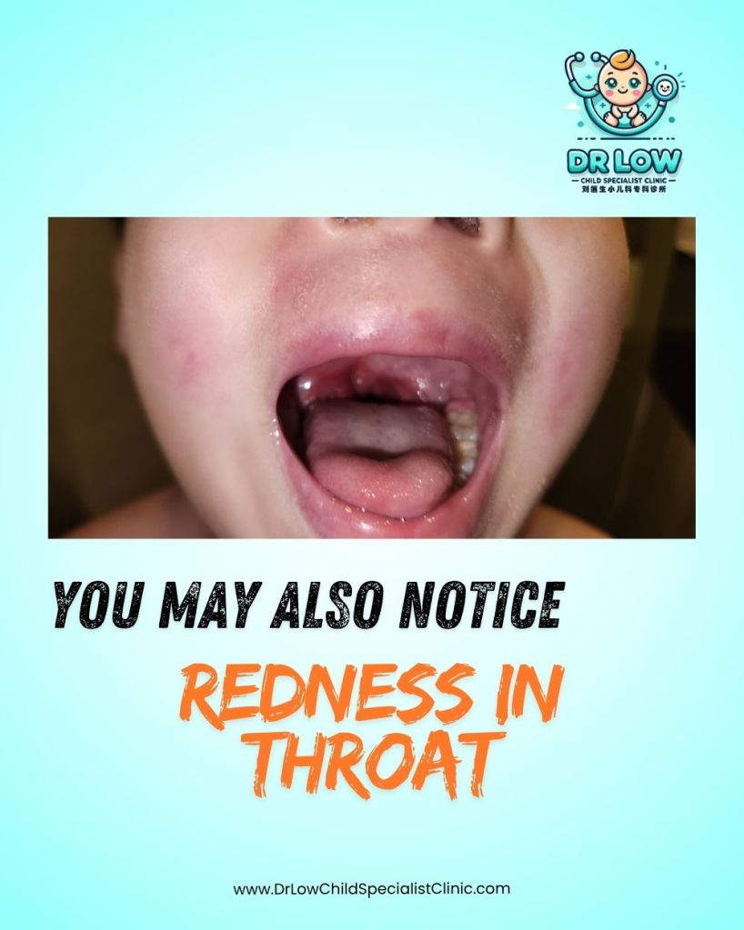 Demam Scarlet pada Kanak-Kanak - Simptom dan Rawatan dan Bila Perlu Jumpa Doktor - Klinik Pakar Kanak-kanak Batu Pahat Dr Low 05