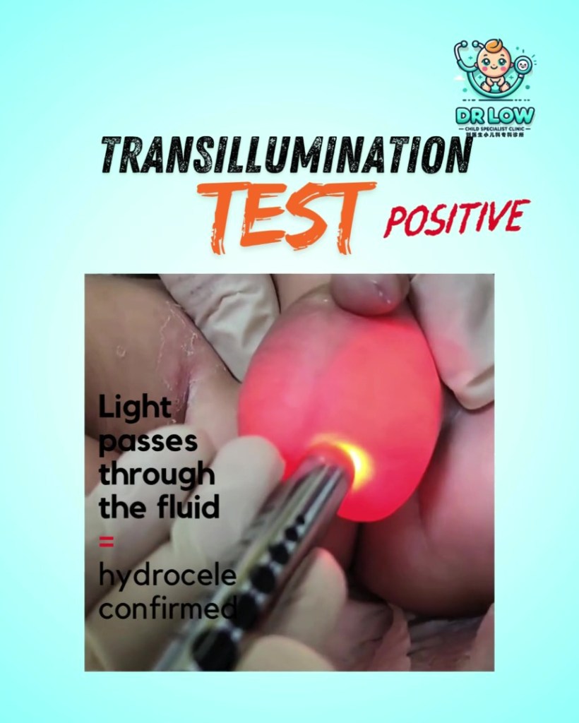 Hydrocele pada Kanak-Kanak – Ibu Bapa di Batu Pahat Perlu&nbsp;Tahu