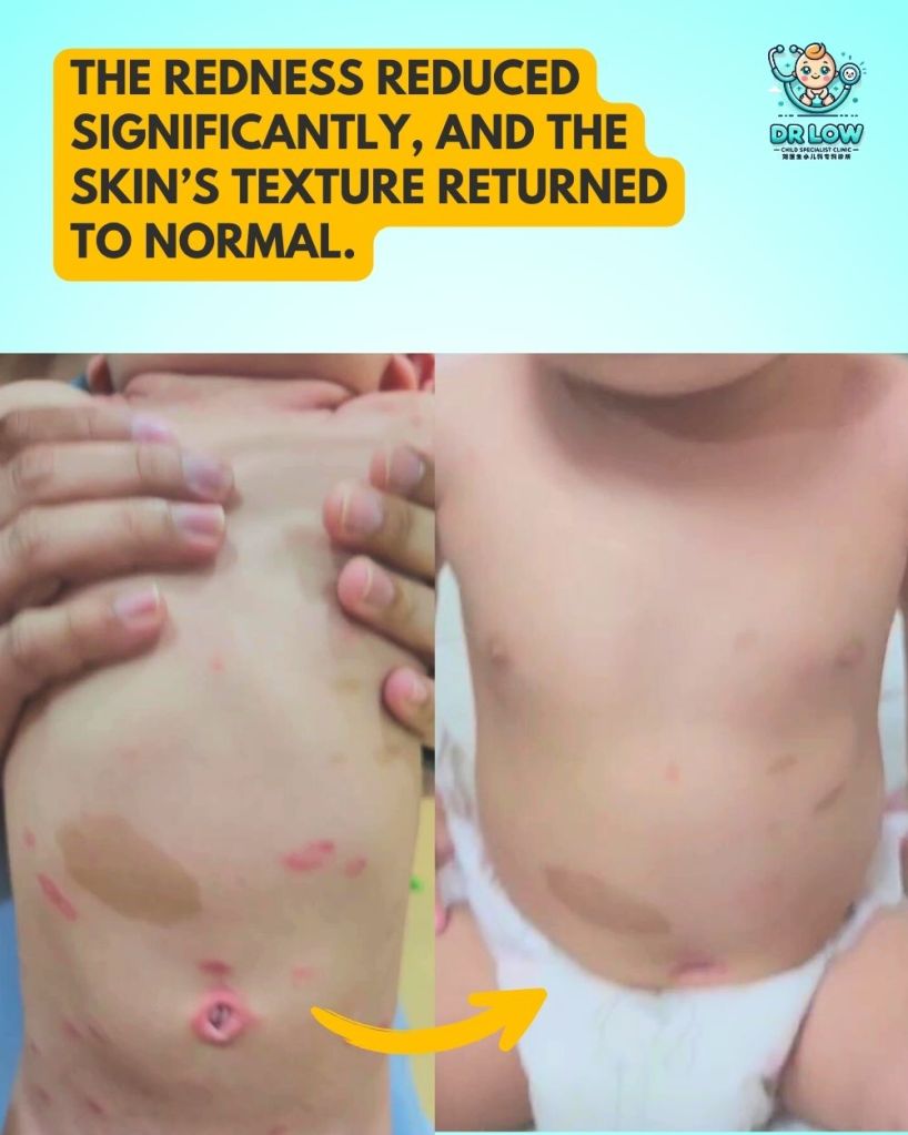 rawatan kulit bayi sebelum selepas batu pahat 05