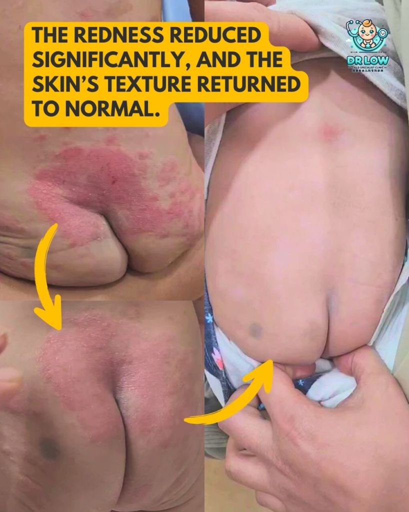 Dari Keradangan ke Sembuh: Pemulihan Kulit Bayi di Klinik Pakar Kanak-kanak Batu Pahat Dr&nbsp;Low