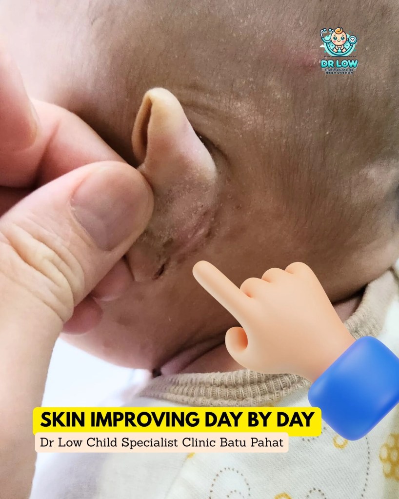 Successful Recovery from Atopic Dermatitis with Skin Infection in Batu Pahat - Dr Low Child Specialist Clinic BP 05