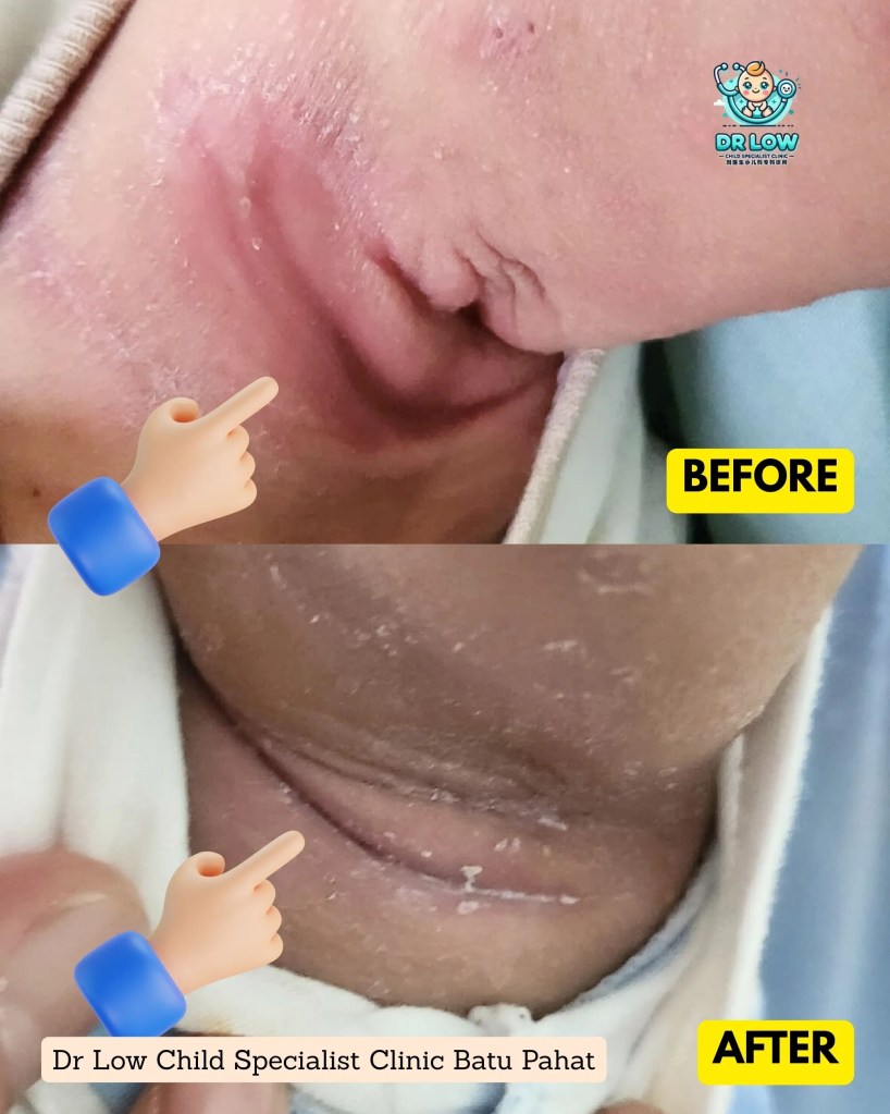 Successful Recovery from Atopic Dermatitis with Skin Infection in Batu Pahat - Dr Low Child Specialist Clinic BP 07