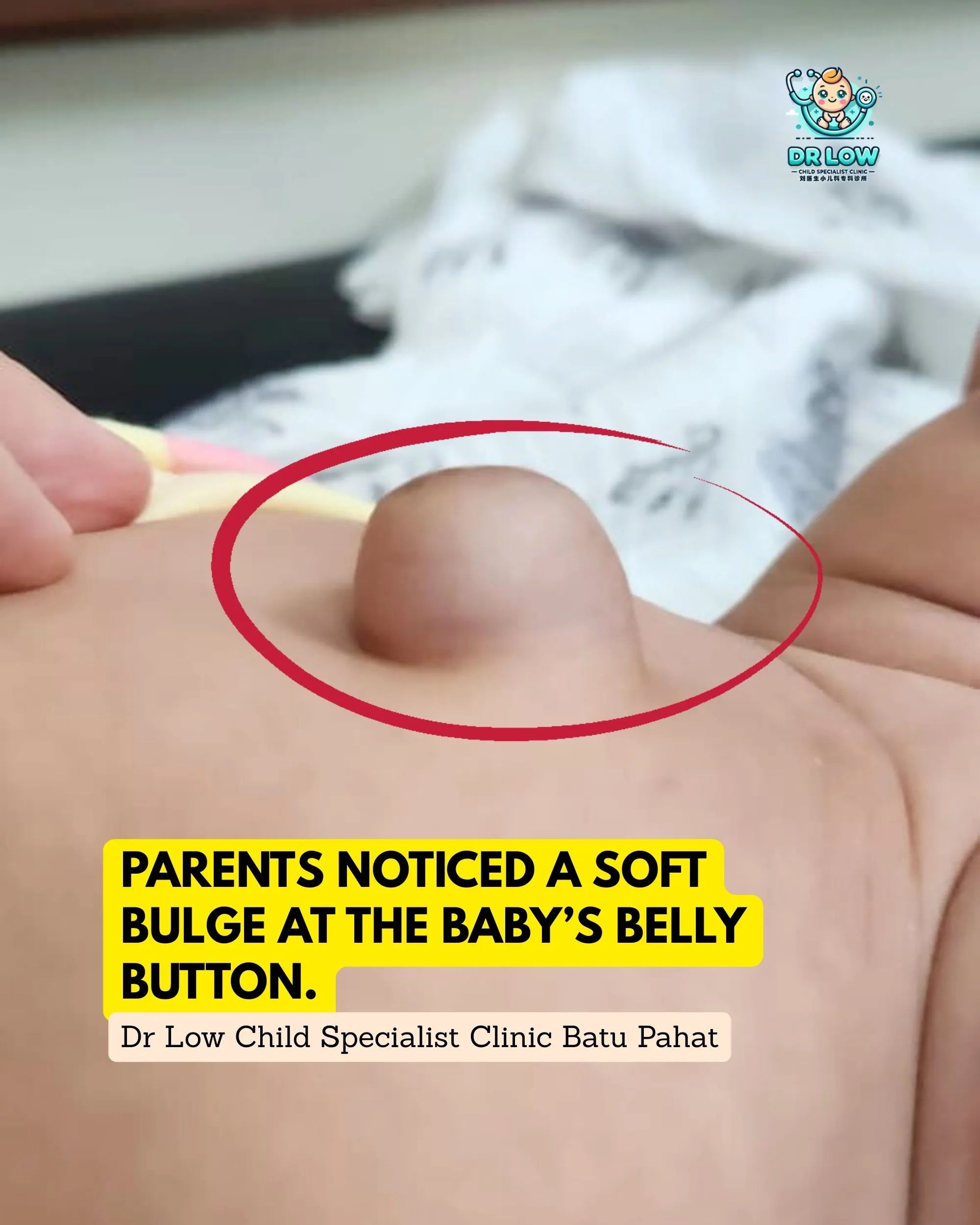 Umbilical Hernia in Babies - Diagnosis Care and Recovery at Dr Low Child Specialist Clinic Batu Pahat Klinik Pakar Kanak-kanak BP 02