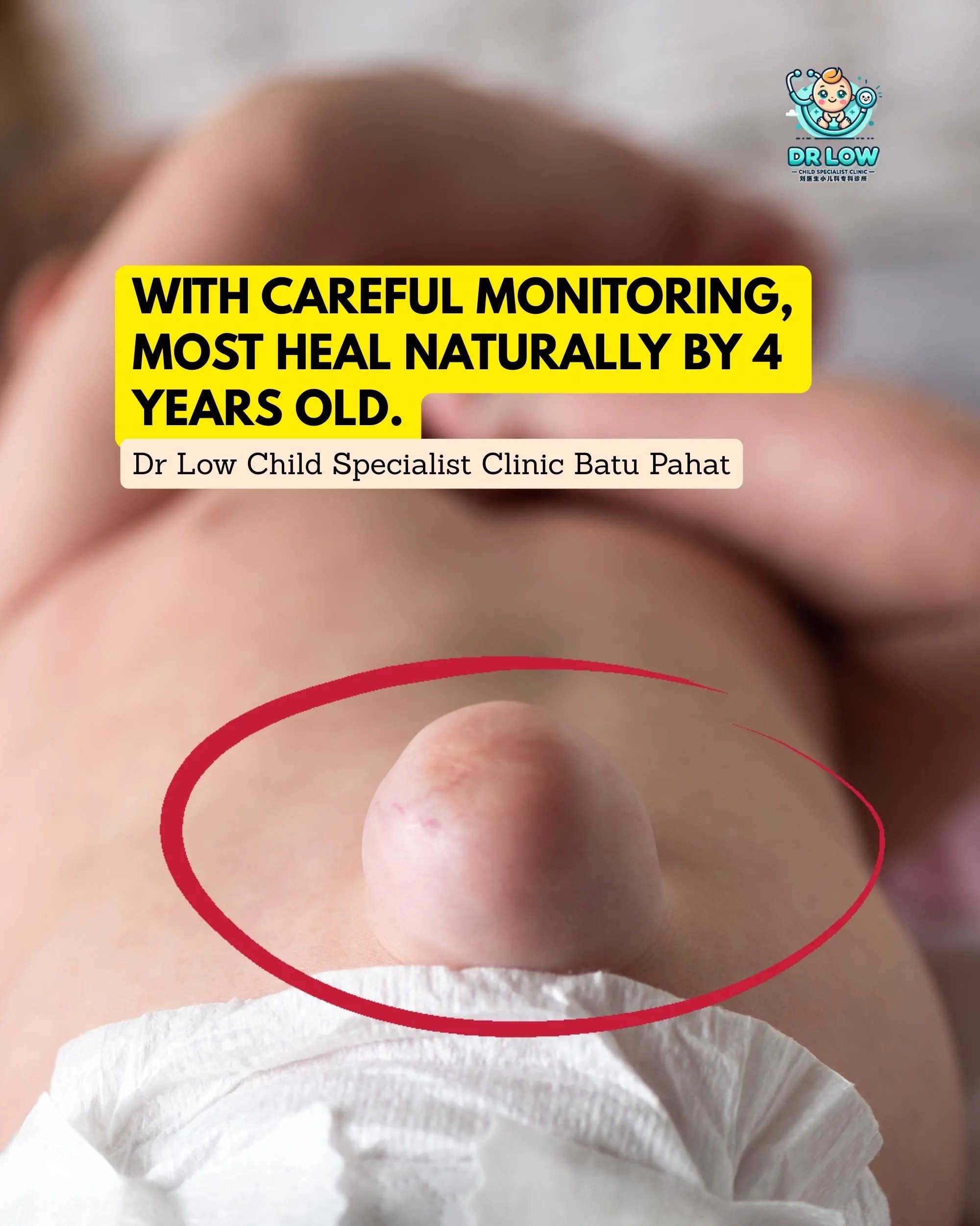 Umbilical Hernia in Babies - Diagnosis Care and Recovery at Dr Low Child Specialist Clinic Batu Pahat Klinik Pakar Kanak-kanak BP 04