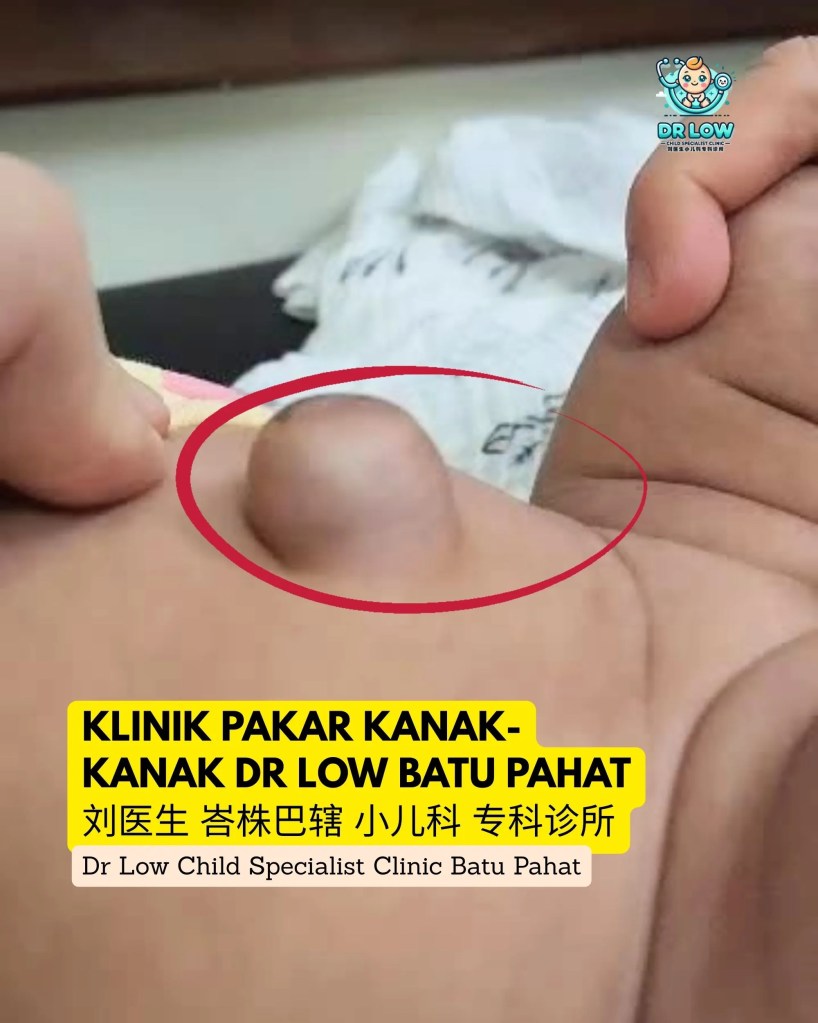 Umbilical Hernia in Babies - Diagnosis Care and Recovery at Dr Low Child Specialist Clinic Batu Pahat Klinik Pakar Kanak-kanak BP 09