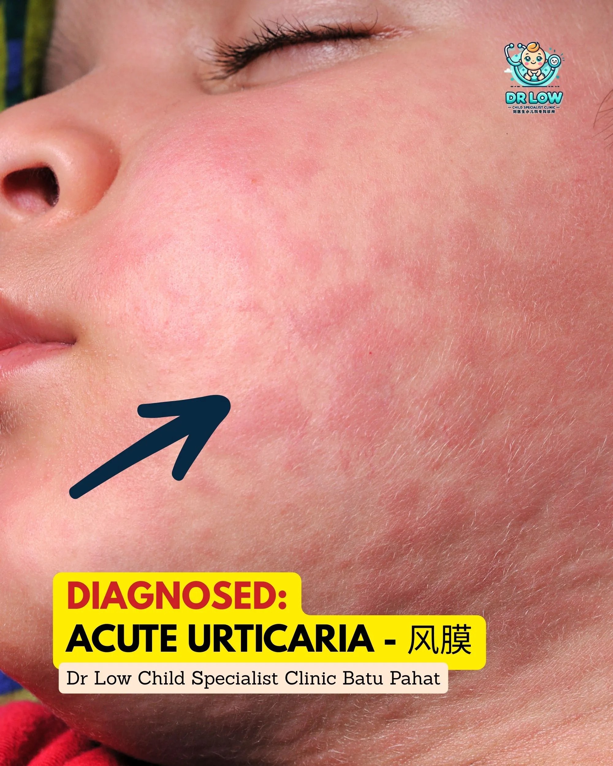 Brave Little Patient with Allergic Skin Reaction - Urticaria Care at Dr Low Child Specialist Clinic Batu Pahat Johor 03