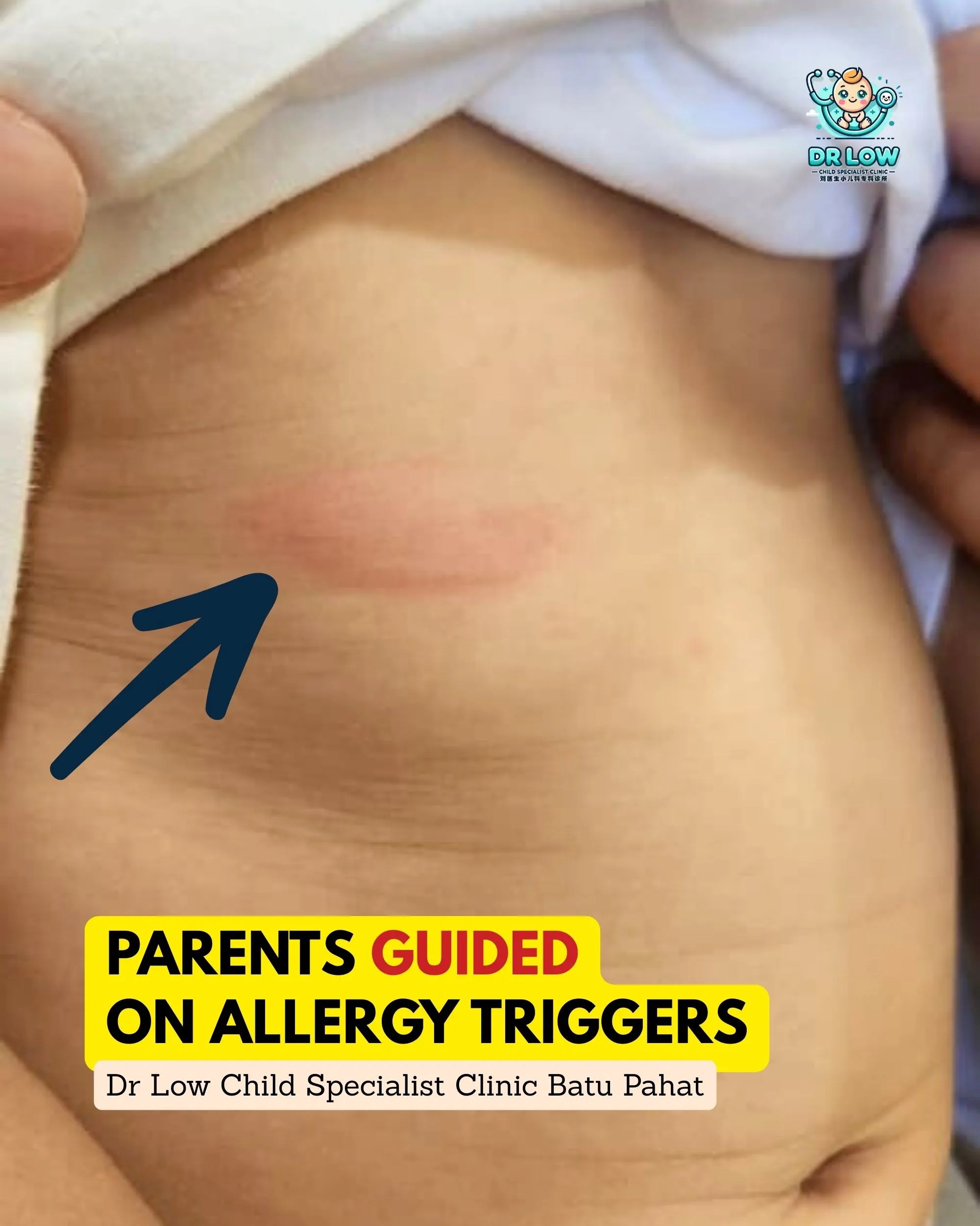 Brave Little Patient with Allergic Skin Reaction - Urticaria Care at Dr Low Child Specialist Clinic Batu Pahat Johor 06