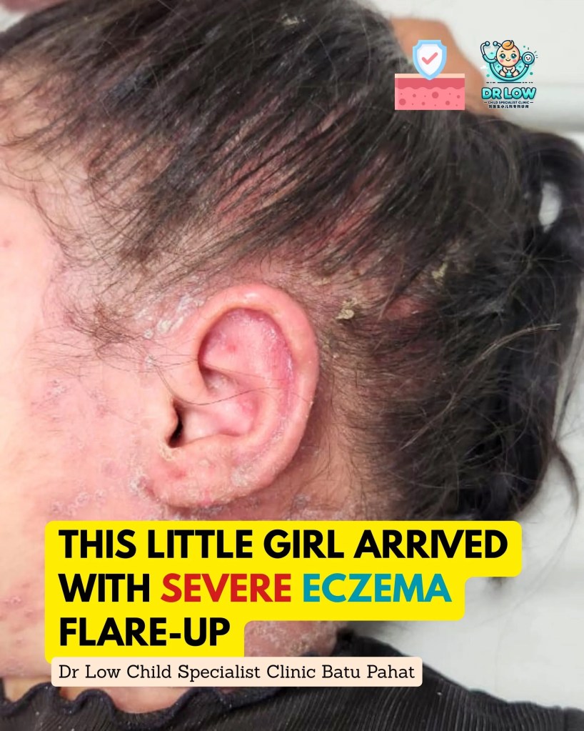 Severe Atopic Dermatitis with Skin Infection in Batu Pahat Johor Malaysia – A Child’s Recovery Journey at Dr Low Child Specialist Clinic Batu Pahat BP 02