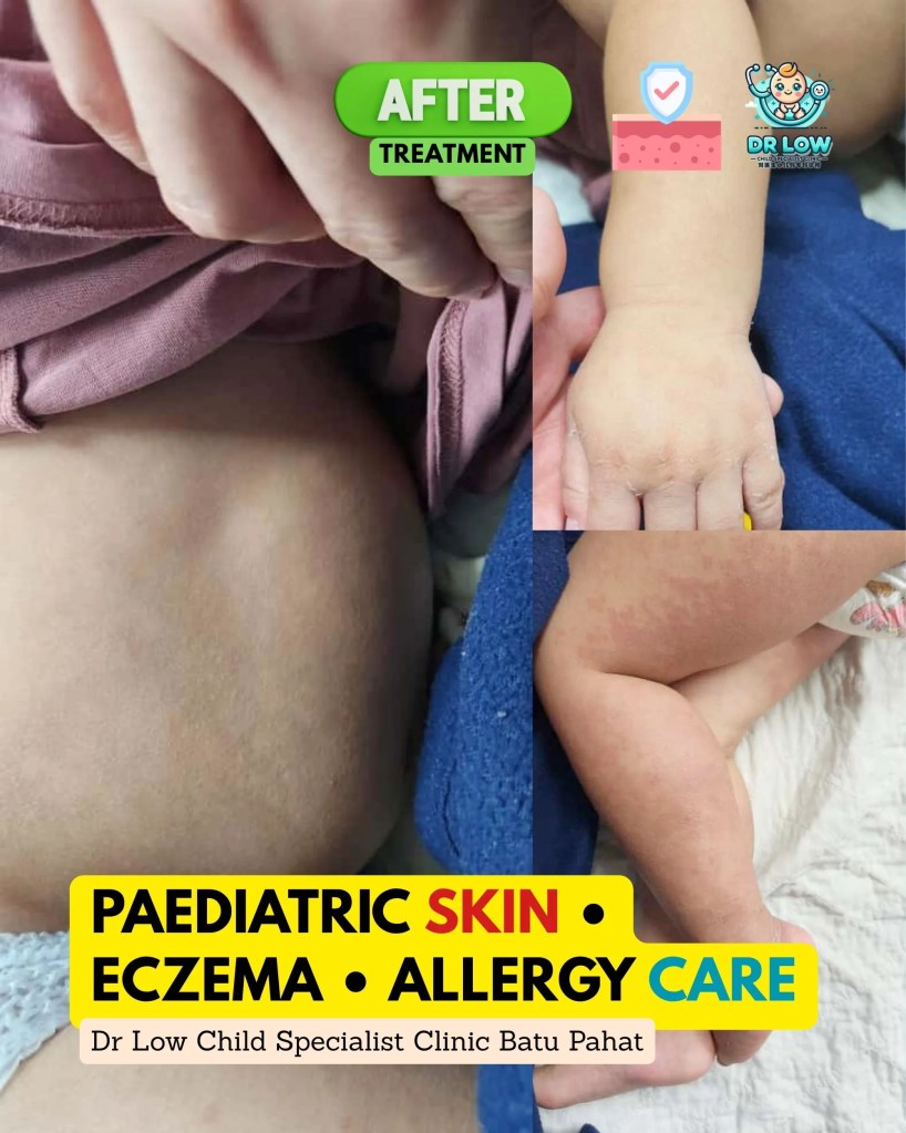 Severe Atopic Dermatitis with Skin Infection in Batu Pahat Johor Malaysia – A Child’s Recovery Journey at Dr Low Child Specialist Clinic Batu Pahat BP 09
