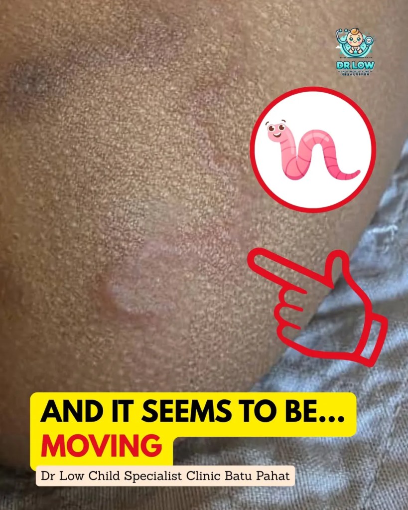 Creeping Skin Rash in Children BP - Cutaneous Larva Migrans in Batu Pahat - From Diagnosis to Recovery on Child Specialist Clinic Batu Pahat Dr Low 04