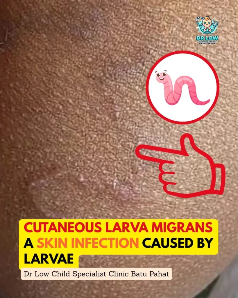 Creeping Skin Rash in Children BP - Cutaneous Larva Migrans in Batu Pahat - From Diagnosis to Recovery on Child Specialist Clinic Batu Pahat Dr Low 07