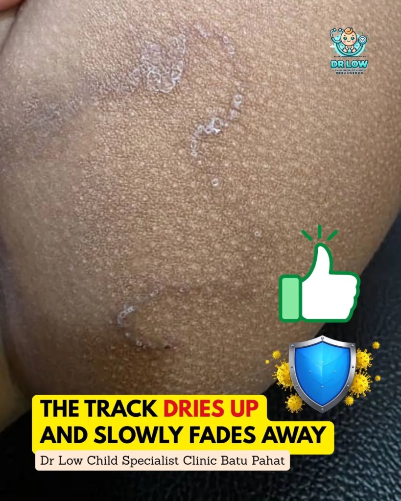 Creeping Skin Rash in Children BP - Cutaneous Larva Migrans in Batu Pahat - From Diagnosis to Recovery on Child Specialist Clinic Batu Pahat Dr Low 09