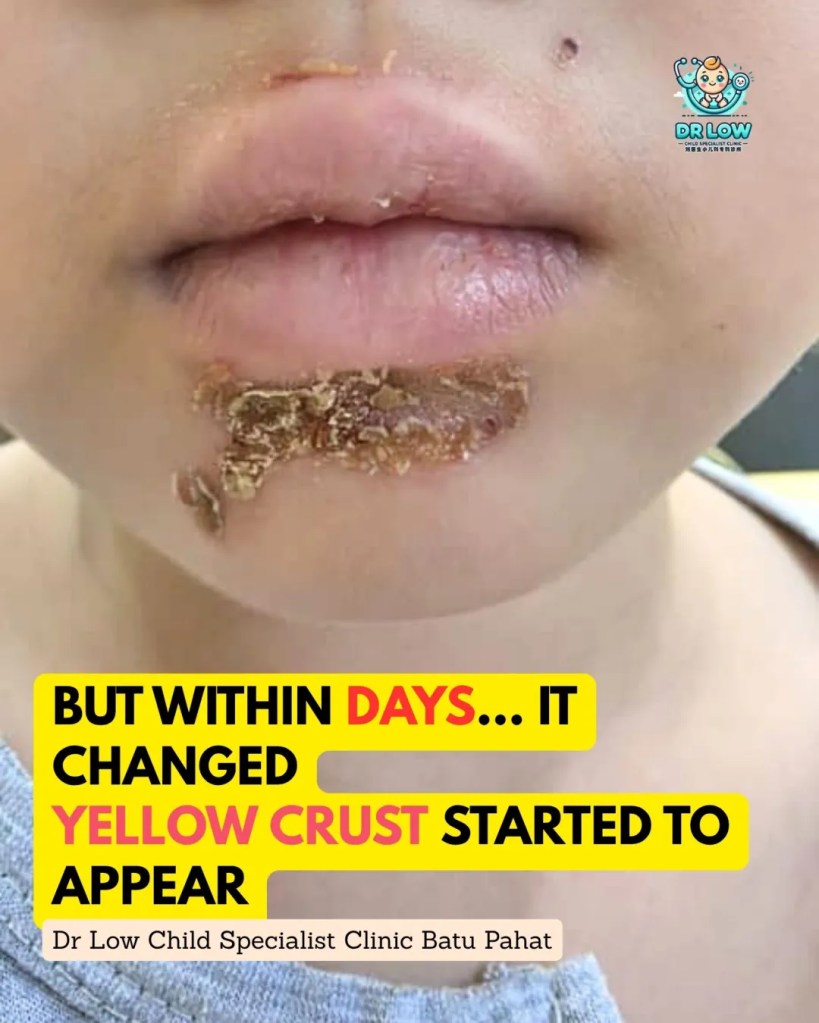 Impetigo Chin Infection in Child BP - Treatment and Recovery in BP - Child Specialist Clinic Batu Pahat Johor 02