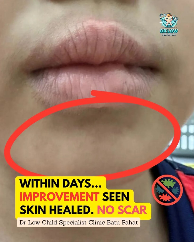Impetigo Chin Infection in Child BP - Treatment and Recovery in BP - Child Specialist Clinic Batu Pahat Johor 07