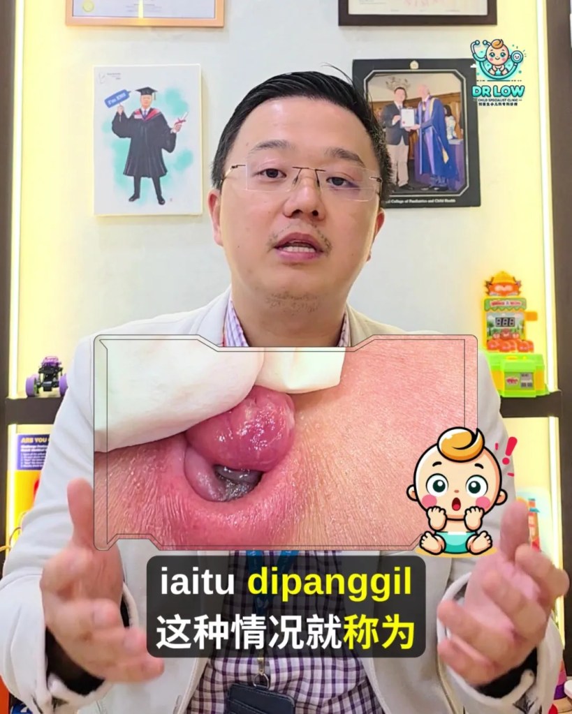 Pusat Bayi Ada Ketulan Merah Selepas Tali Pusat Gugur - Kenali Umbilical Granuloma - Dr Low Child Specialist Clinic Batu Pahat Johor Malaysia A07
