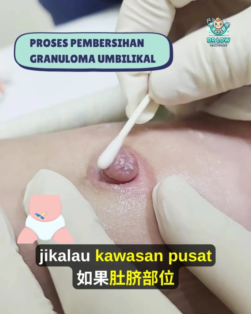 Pusat Bayi Ada Ketulan Merah Selepas Tali Pusat Gugur - Kenali Umbilical Granuloma - Dr Low Child Specialist Clinic Batu Pahat Johor Malaysia A14