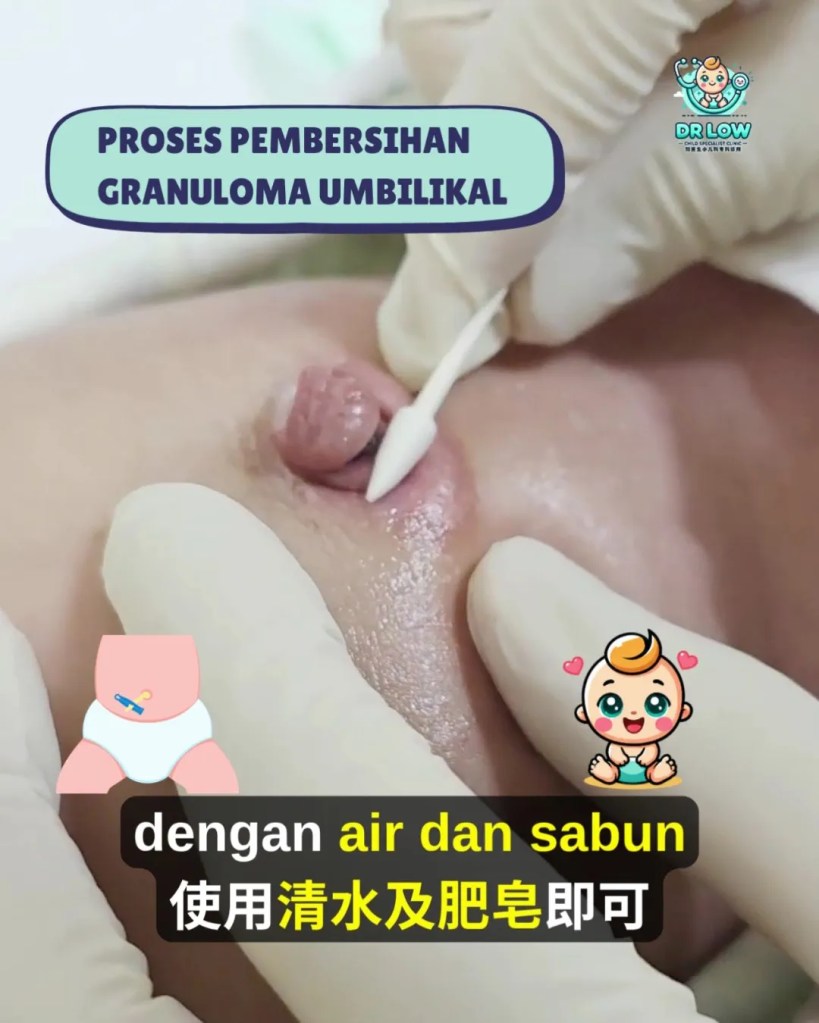 Pusat Bayi Ada Ketulan Merah Selepas Tali Pusat Gugur - Kenali Umbilical Granuloma - Dr Low Child Specialist Clinic Batu Pahat Johor Malaysia A16
