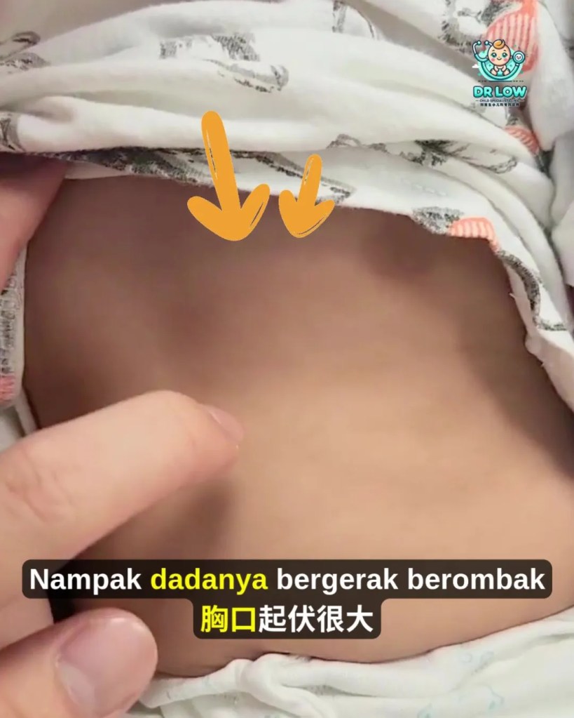 RSV Pada Bayi dan Kanak-Kanak BP - Tanda Awal, Gejala Berbahaya, Rawatan dan Cara Pencegahan - Dr Low Child Specialist Clinic Batu Pahat Johor A20