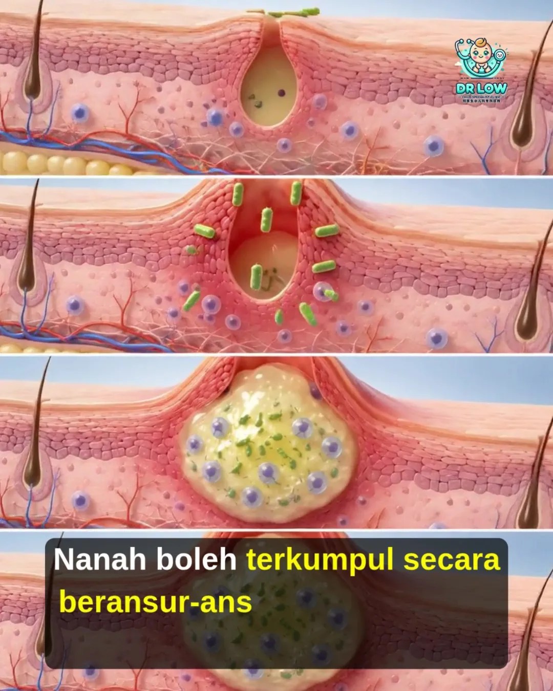 Jangkitan Bakteria Kulit dan Abses pada Bayi BP - Rawatan Incision and Drainage untuk Mengeluarkan Nanah - Dr Low Child Specialist Batu Pahat Johor Malaysia A05