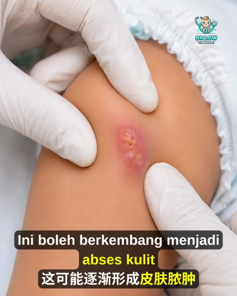 Jangkitan Bakteria Kulit dan Abses pada Bayi BP - Rawatan Incision and Drainage untuk Mengeluarkan Nanah - Dr Low Child Specialist Batu Pahat Johor Malaysia A07