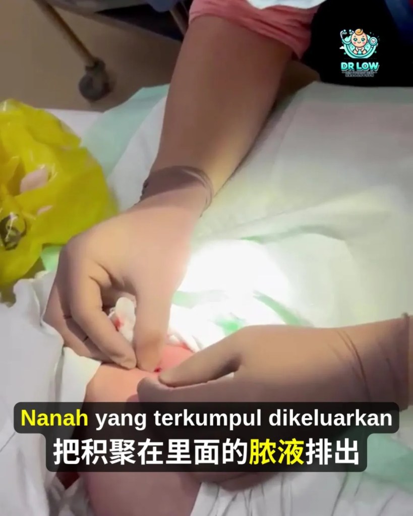 Jangkitan Bakteria Kulit dan Abses pada Bayi BP - Rawatan Incision and Drainage untuk Mengeluarkan Nanah - Dr Low Child Specialist Batu Pahat Johor Malaysia A11