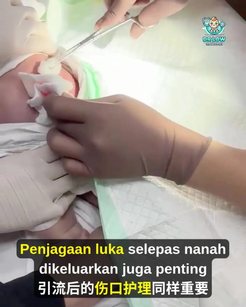 Jangkitan Bakteria Kulit dan Abses pada Bayi BP - Rawatan Incision and Drainage untuk Mengeluarkan Nanah - Dr Low Child Specialist Batu Pahat Johor Malaysia A14